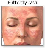 Butterfly facial rash due to Lupus.  Click to enlarge for more information