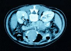 MRI scan, showing the kidneys top left and right - click to enlarge
